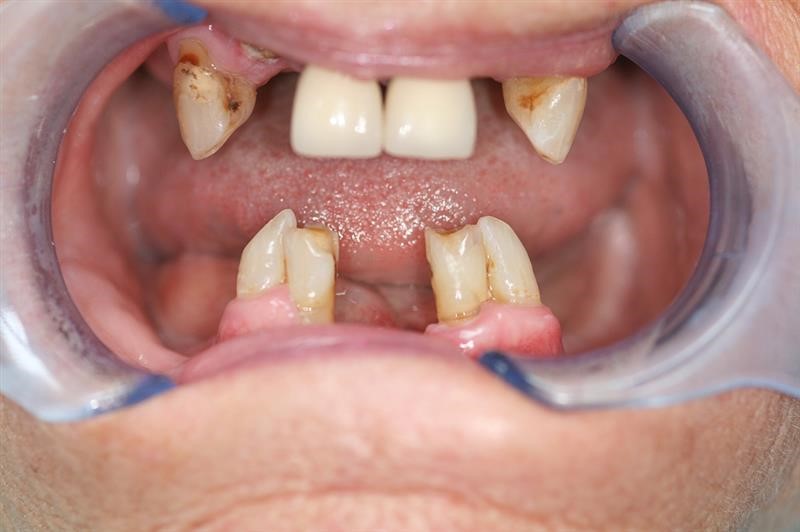 No Immediate Dentures Coker AL 35452